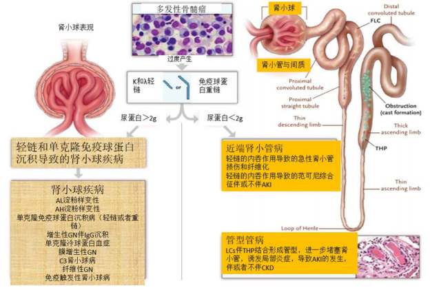 急性肾腺炎最新论文解析：病原构况、新型治疗技术及未来发展趋势