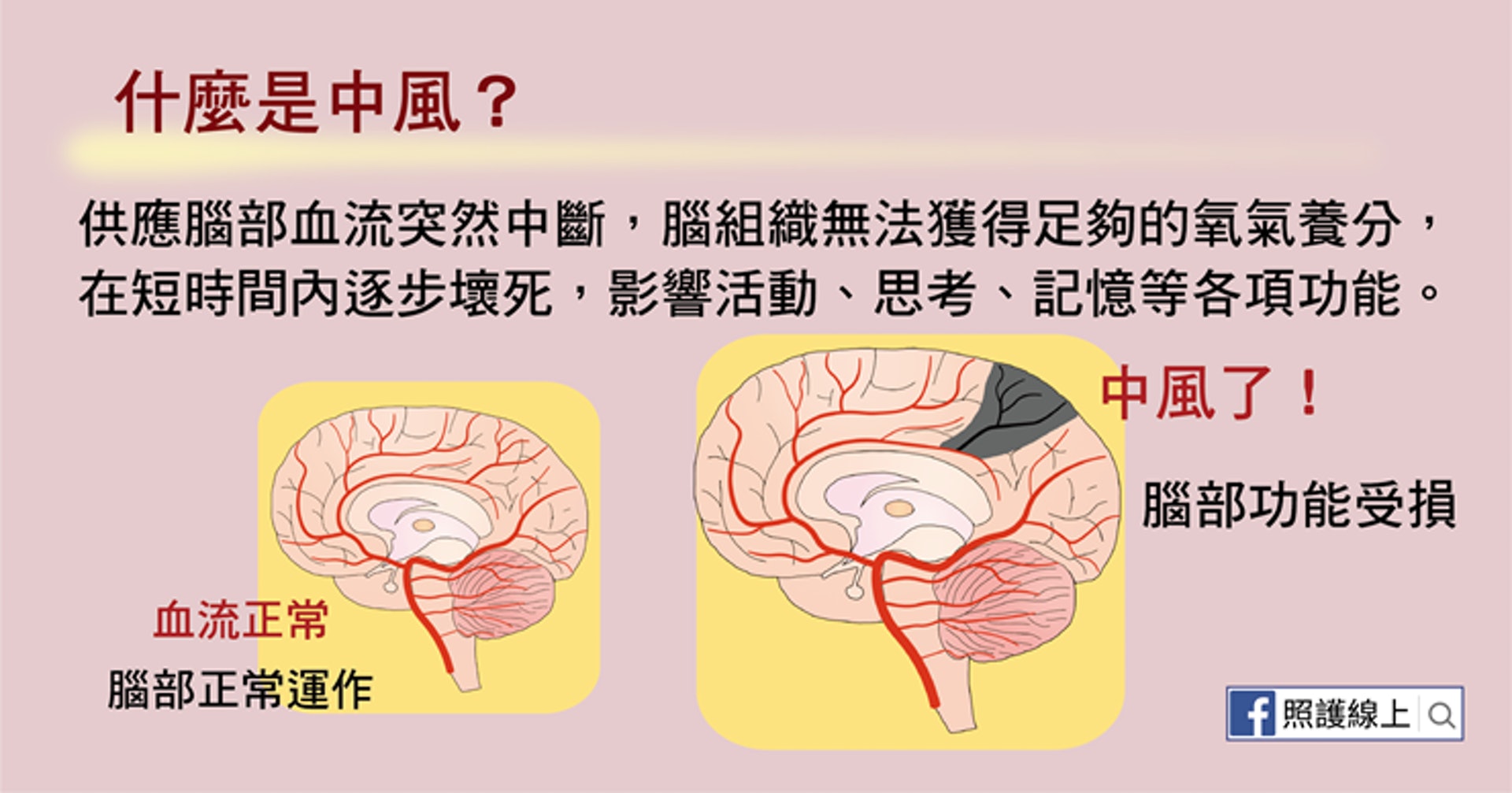 最新脑梗研究进展：预防、治疗及康复新策略