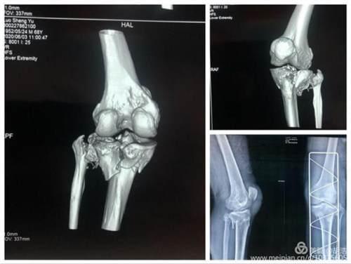 最新骨折研究：从治疗到康复的全面解读及未来趋势预测